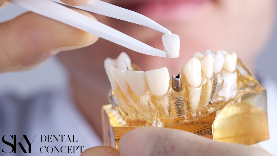 zubni implant