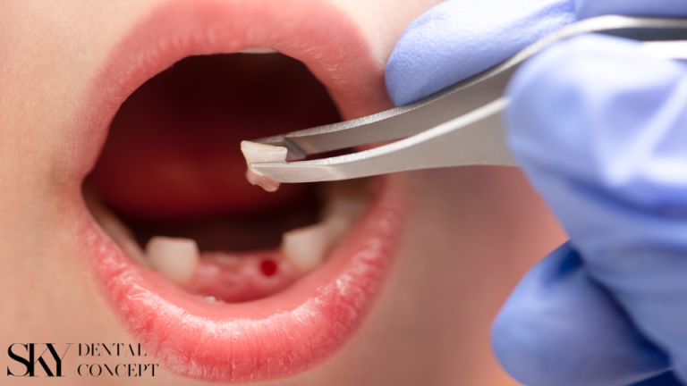 alveolitis