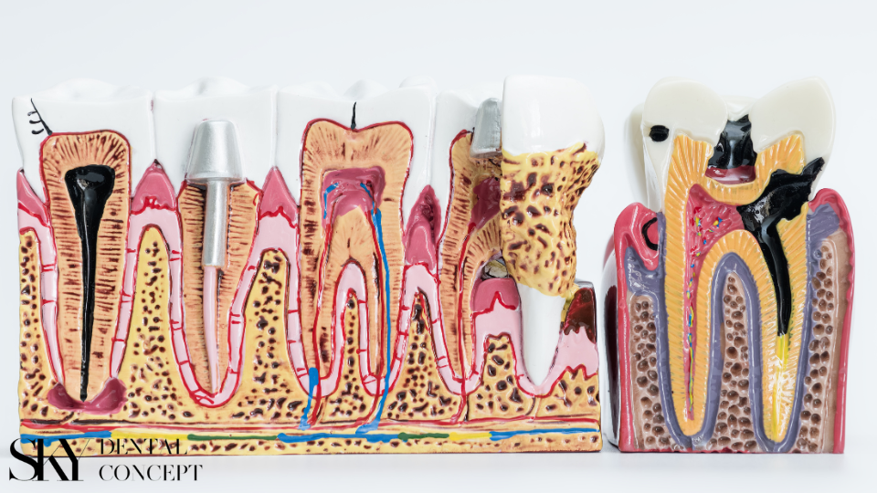 alveolitis zuba