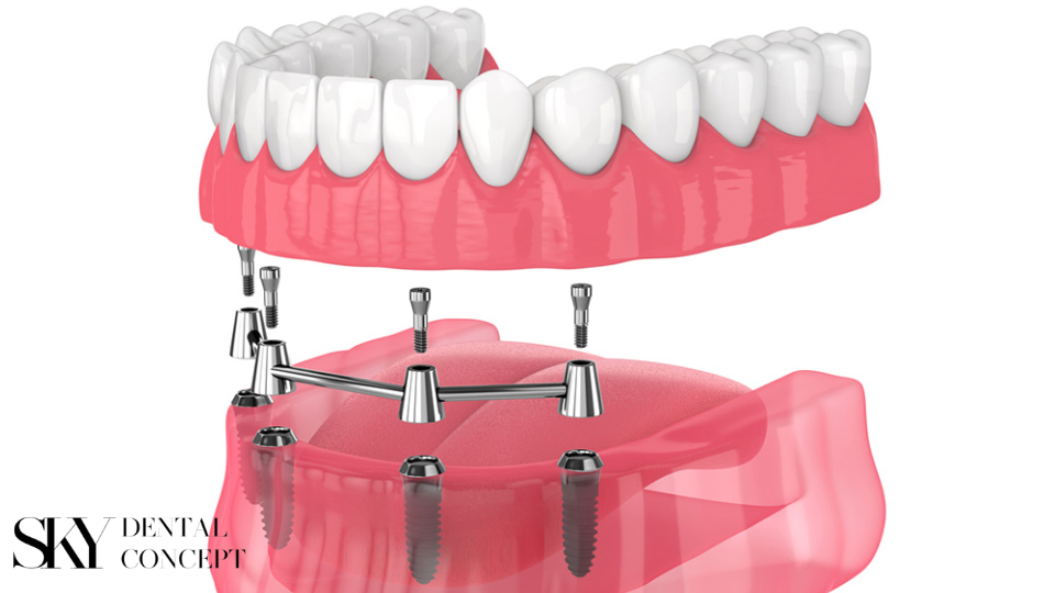 all on 4 implants
