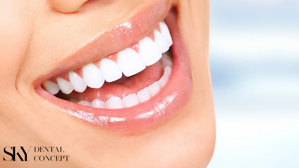 hollywood-smile-sky-dental