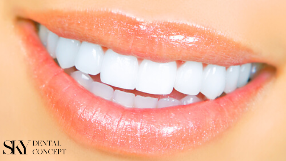 hollywood smile