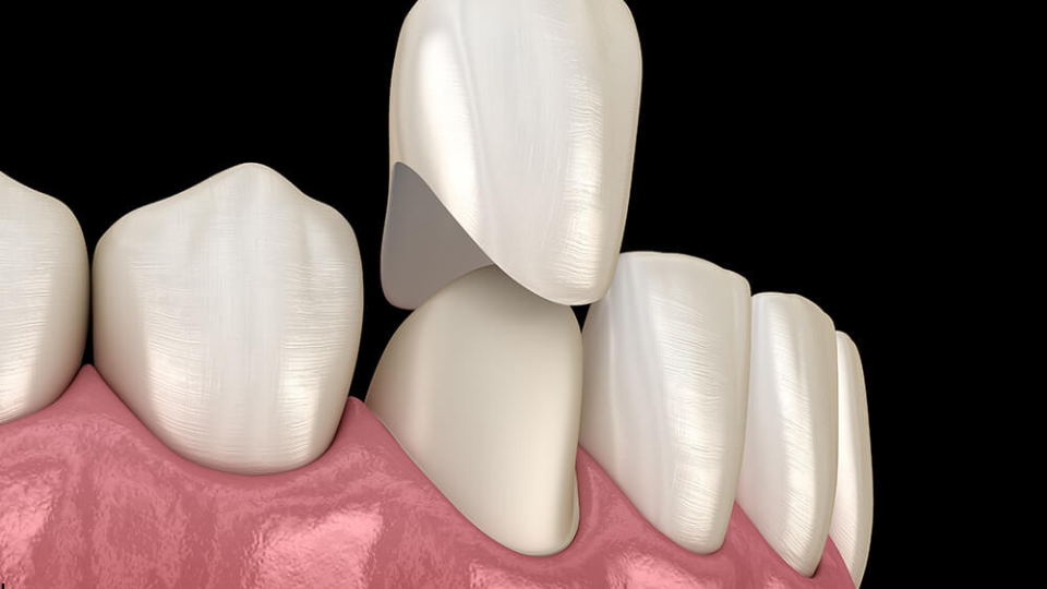 tooth-preparation-2